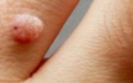 How to Remove Skin Tags and Warts Overnight: Safe and Effective Methods