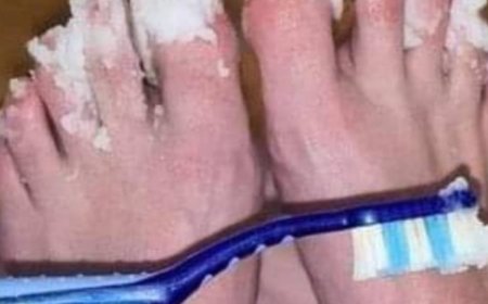 Natural Remedy for Nail Fungus: Effective Treatment for Quick Relief