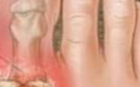 8 Easy Ways to Remove Excess Uric Acid(Easier Than You Think)