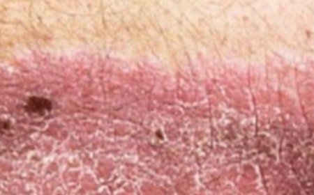 This Vitamin Removes Psoriasis Forever  (UNBELIEVABLE) 