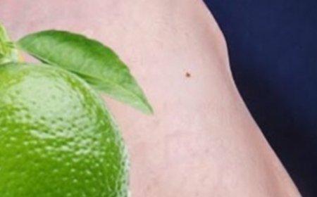 Lemon Removes Varicose Veins! Just Do This Before Bed…