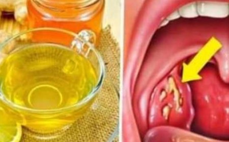 Natural Remedies for Tonsillitis: Soothe Your Throat and Find Relief