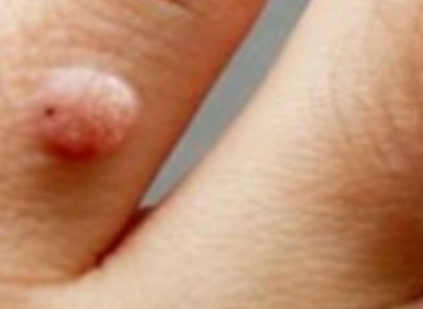 How to Remove Skin Tags and Warts Overnight: Safe and Effective Methods