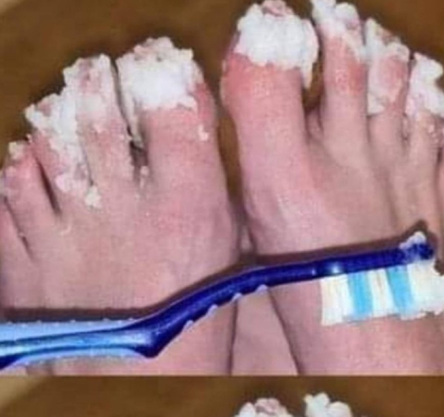 Natural Remedy for Nail Fungus: Effective Treatment for Quick Relief