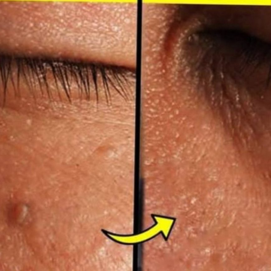 Effective Ways to Remove Skin Tags at Home