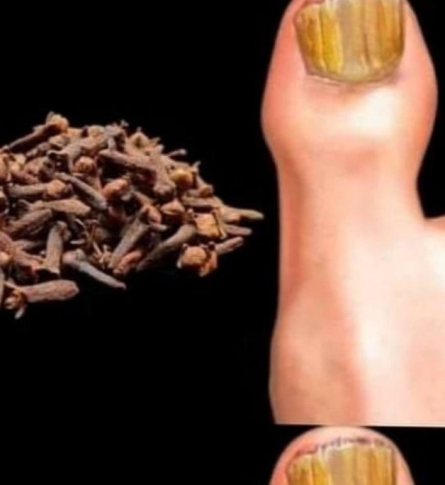 Removes Nail Fungus Instantly, Like an Eraser! The Best Remedy!