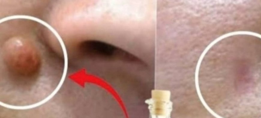 Apple Cider Vinegar: A Natural Solution for Removing Warts in 24 Hours