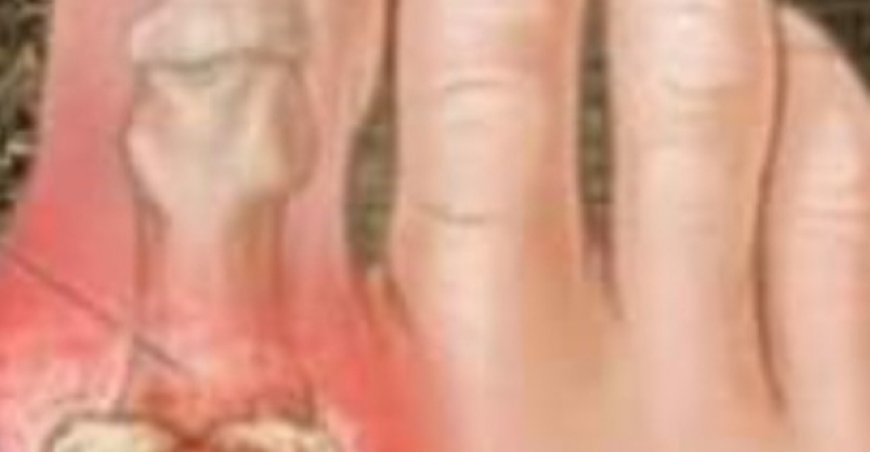 8 Easy Ways to Remove Excess Uric Acid(Easier Than You Think)