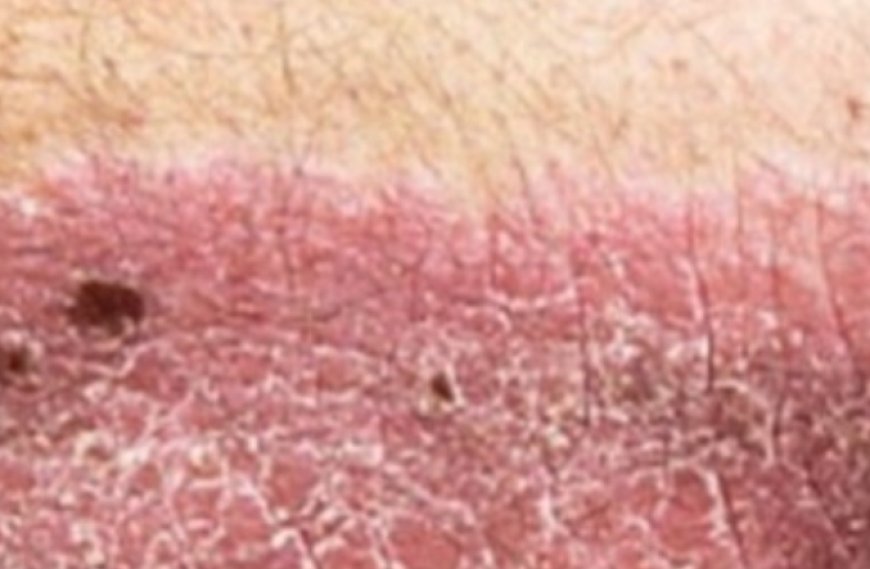 This Vitamin Removes Psoriasis Forever  (UNBELIEVABLE) 