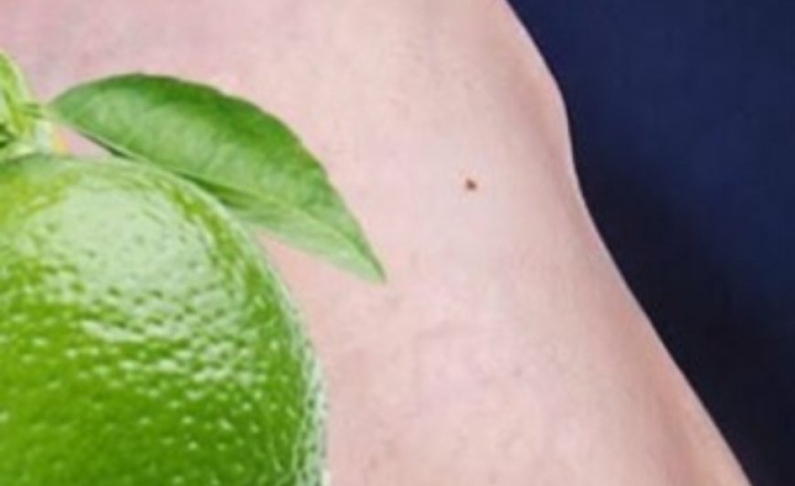 Lemon Removes Varicose Veins! Just Do This Before Bed…