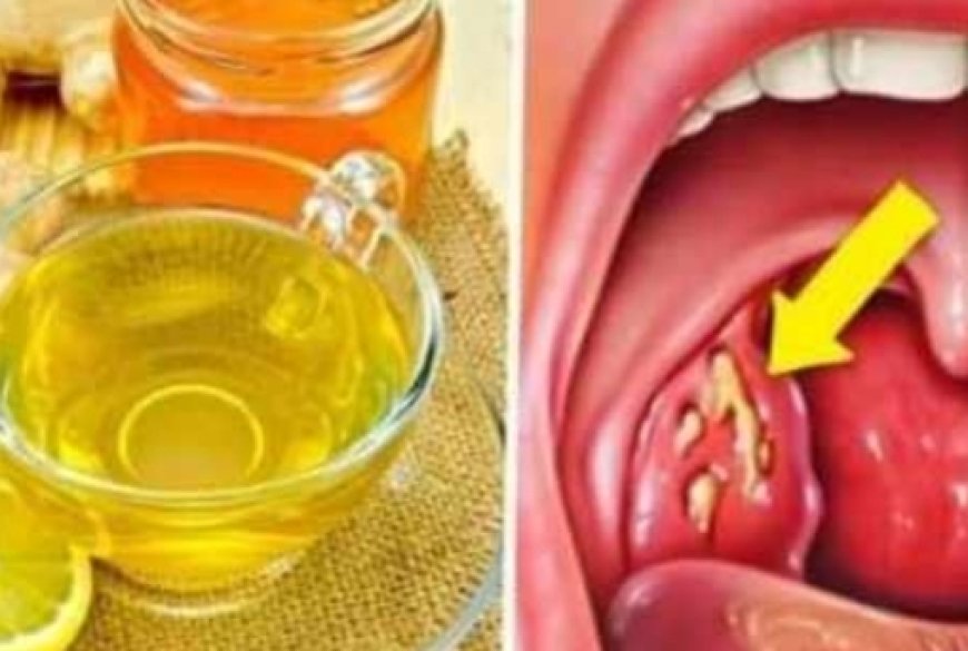 Natural Remedies for Tonsillitis: Soothe Your Throat and Find Relief