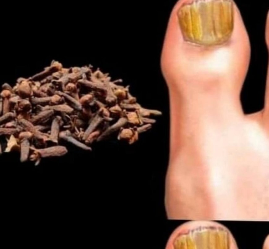 Removes Nail Fungus Instantly, Like an Eraser! The Best Remedy!