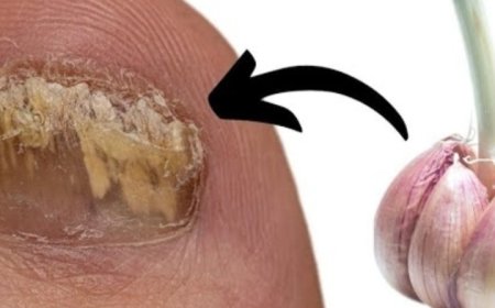 Garlic: A Natural Remedy for Fungal Foot Infections