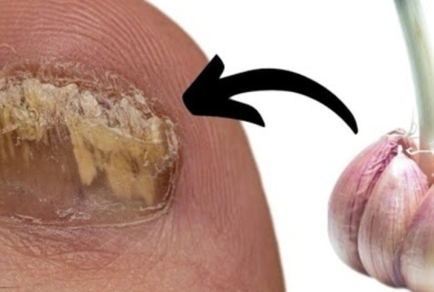 Garlic: A Natural Remedy for Fungal Foot Infections