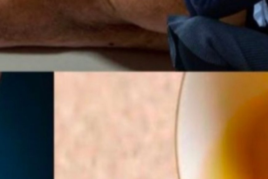 Say Goodbye to Swollen Legs, Ankles & Feet with This Natural Tea!