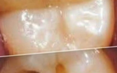 How to Naturally Repair a Cavity: Tips to Keep Your Teeth Strong