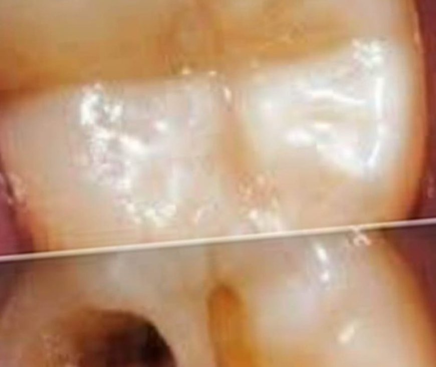 How to Naturally Repair a Cavity: Tips to Keep Your Teeth Strong