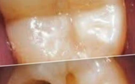 How to Naturally Repair a Cavity: Tips to Keep Your Teeth Strong