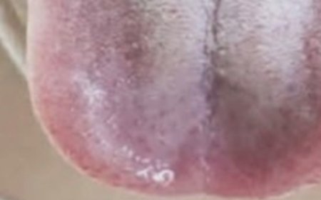 Understanding the Causes of a White Tongue: What Your Tongue May Be Telling You