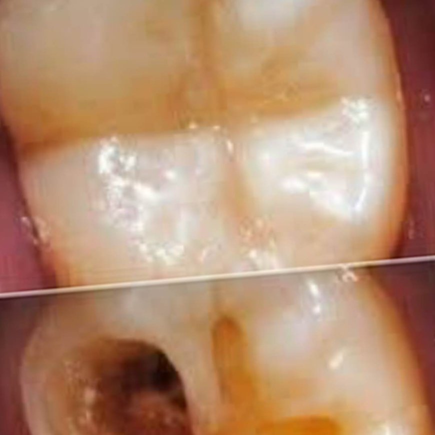 How to Naturally Repair a Cavity: Tips to Keep Your Teeth Strong