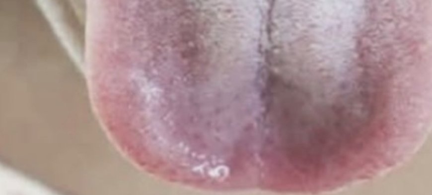 Understanding the Causes of a White Tongue: What Your Tongue May Be Telling You