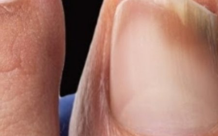 This Is a Nail Fungus Killer! ???????? It Works Very Fast – Just Use Garlic