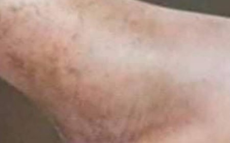 If You Suffer from Poor Circulation and Your Legs Feel Like This, Here Is the Solution