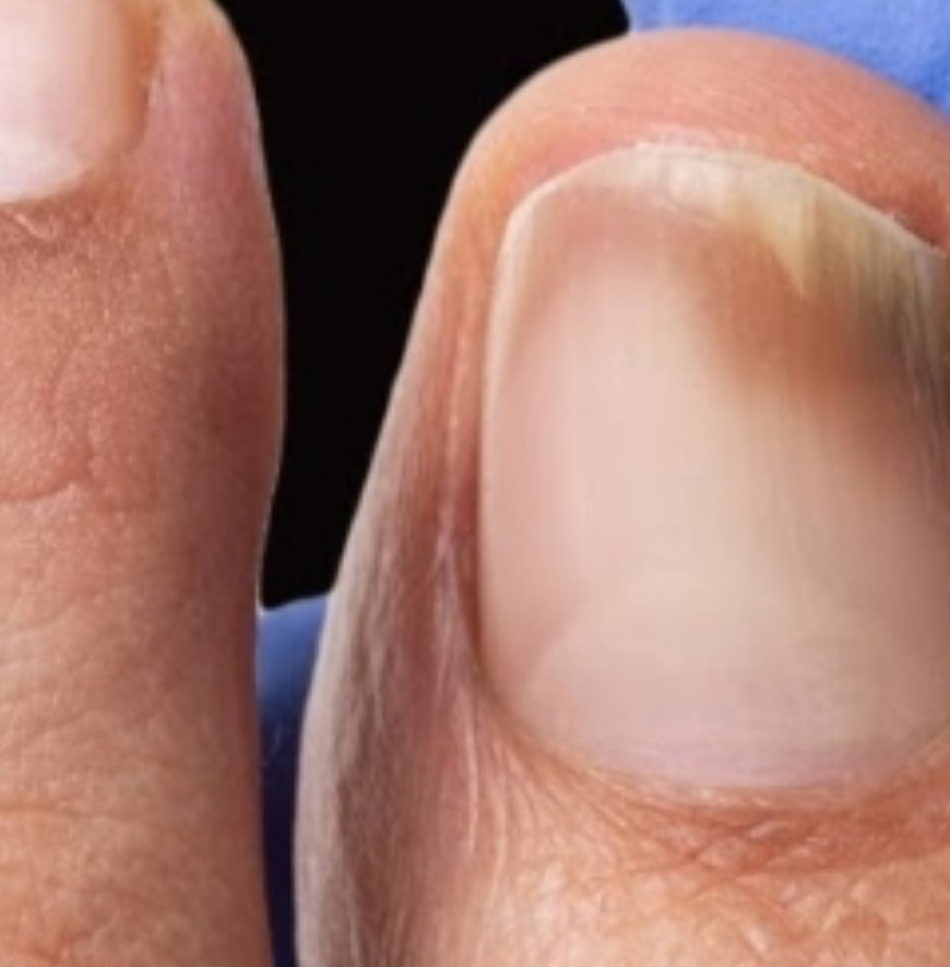 This Is a Nail Fungus Killer! ???????? It Works Very Fast – Just Use Garlic