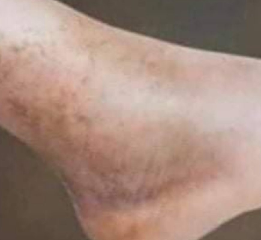 If You Suffer from Poor Circulation and Your Legs Feel Like This, Here Is the Solution