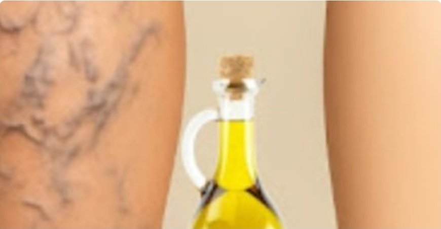 Grandmas Natural Remedy for Varicose Veins Aloe Vera Apple Cider Vinegar and Lemon