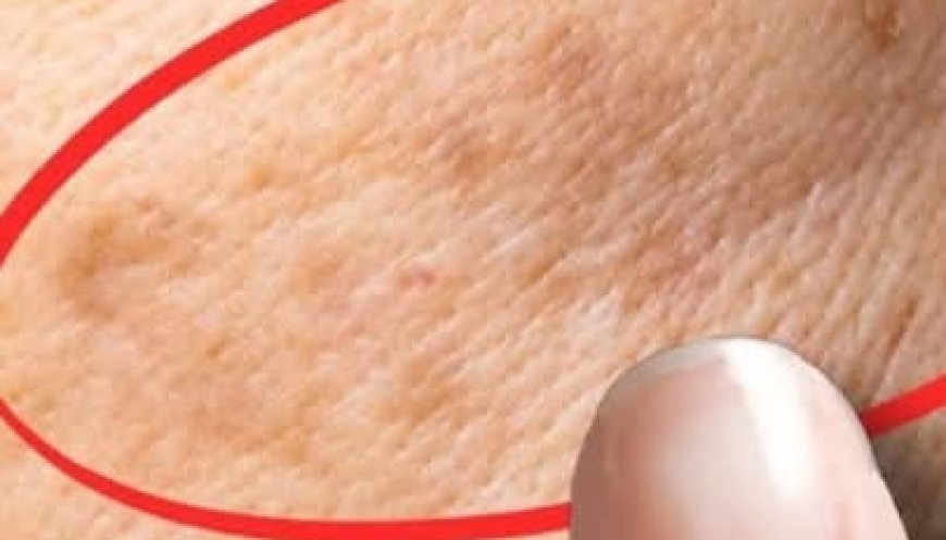 How to Remove Age Spots Naturally with Lemon Juice