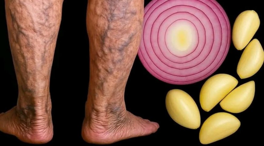 Garlic, Onion & Olive Oil Remedy for Varicose Veins