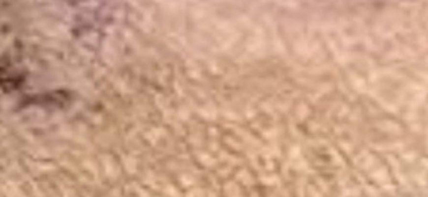 Suffering from Inflamed Kidneys? Cleanse and Purify Them with Just Two